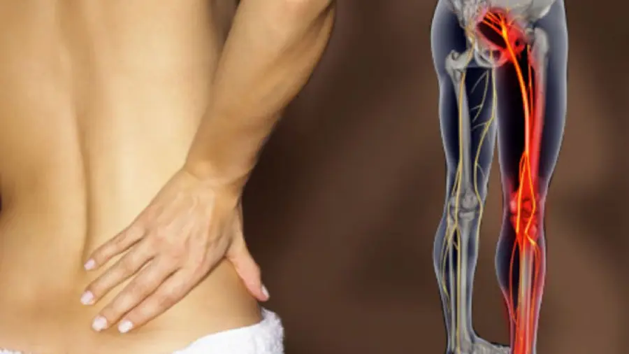 La Sciatica: cause, sintomi e cura