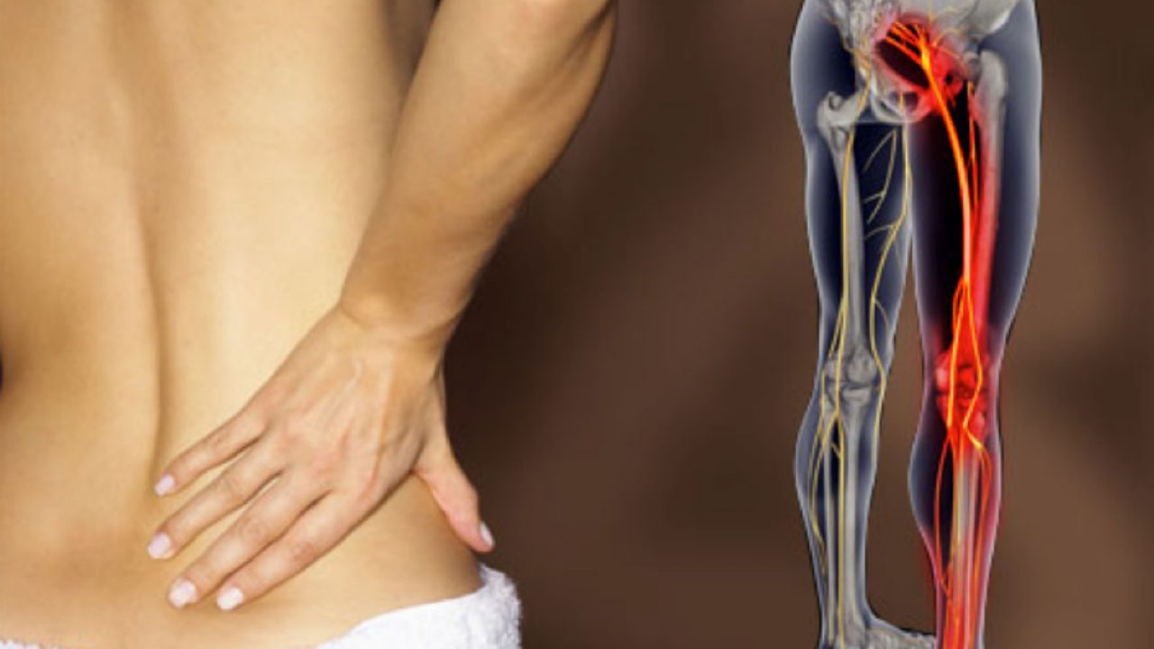 La Sciatica: cause, sintomi e cura